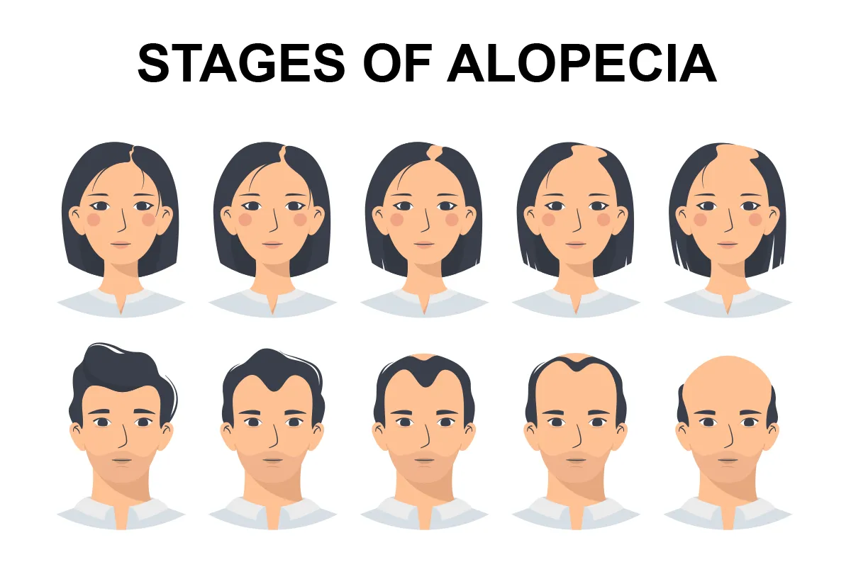 Images shows the stages of alopecia, ranging from minor hair thinning to baldness.