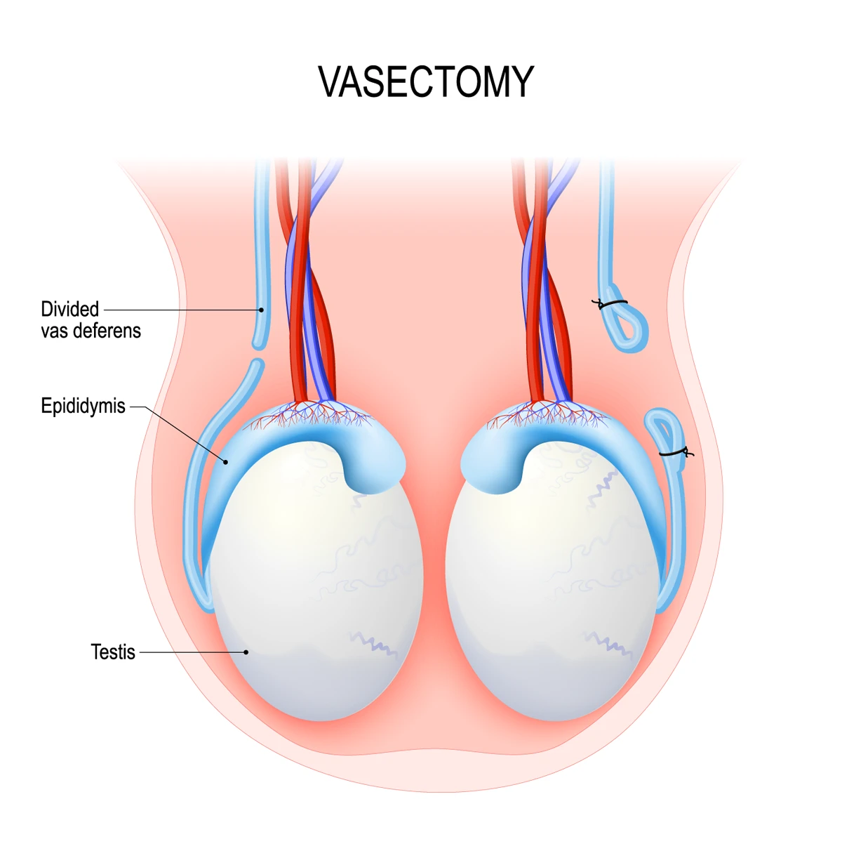 Vasectomy illustration