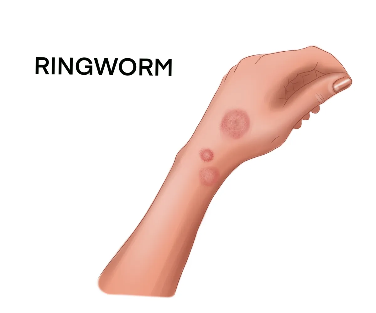Image shows three circular ringworm infections of varying sizes on a human hand and wrist. One spot has a reddened, scaly center and the other two have clear centers.