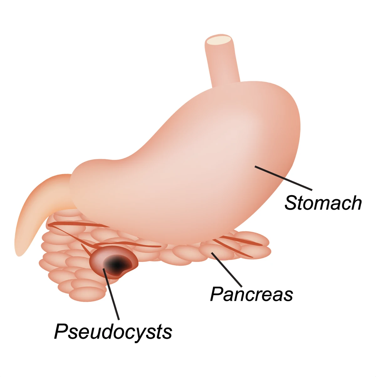 pancreatic pseudocyst