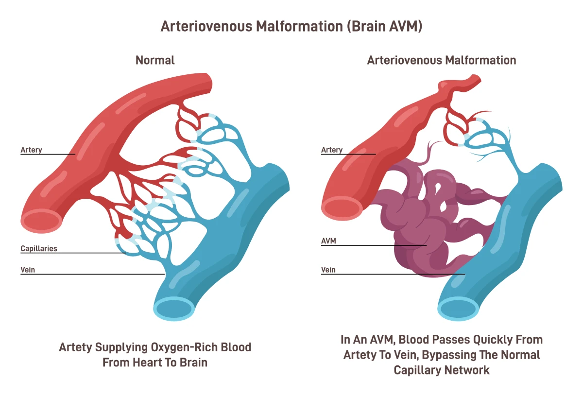 The image shows a normal connection between an artery and a vein compared to an arteriovenous malformation.