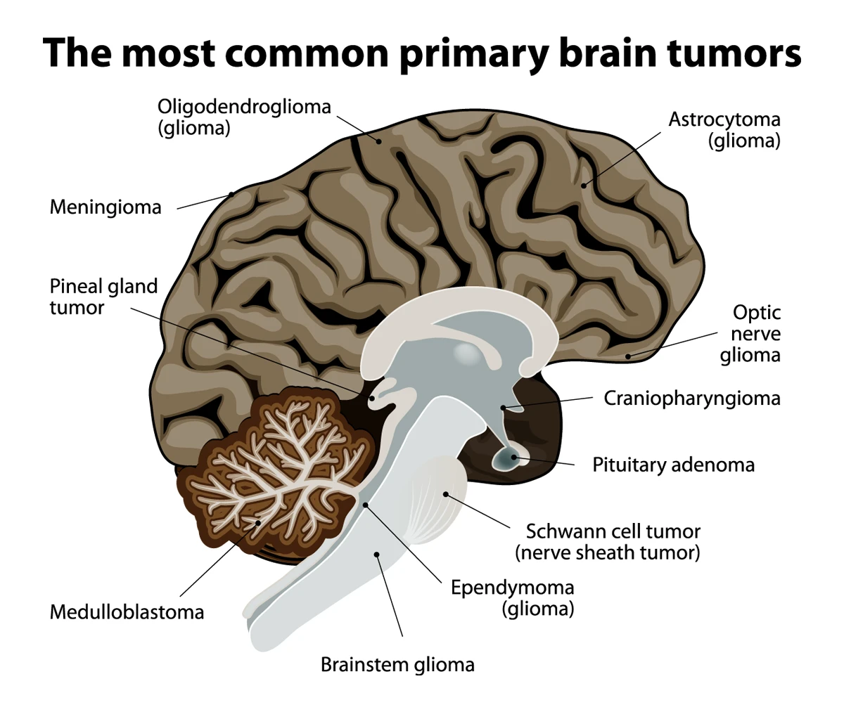 Most common primary brain tumors