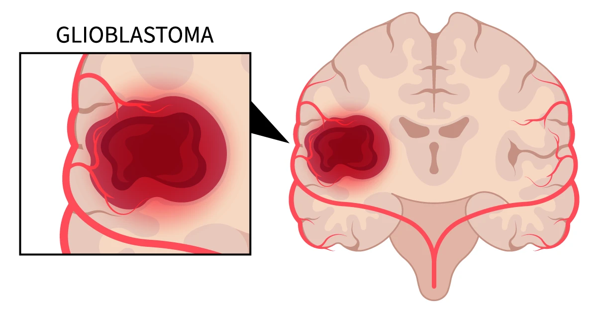 Image shows glioblastoma tumor in brain as if viewed from above.