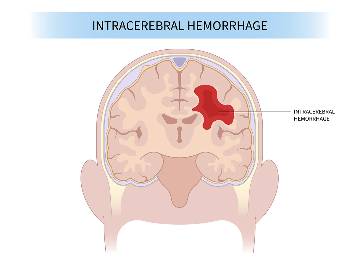 The image shows the location and approximate size of an intracerebral hemorrhage in the brain