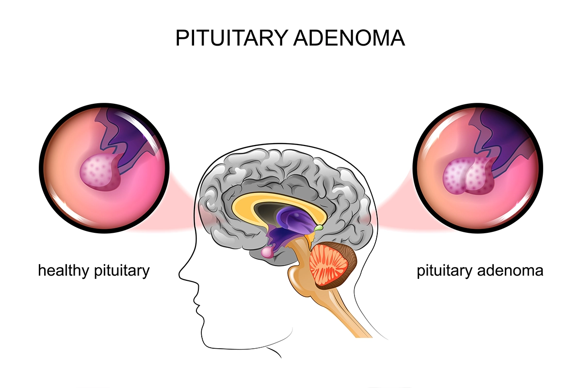 Image shows the difference between a healthy pituitary gland and one with a pituitary adenoma (benign tumor).