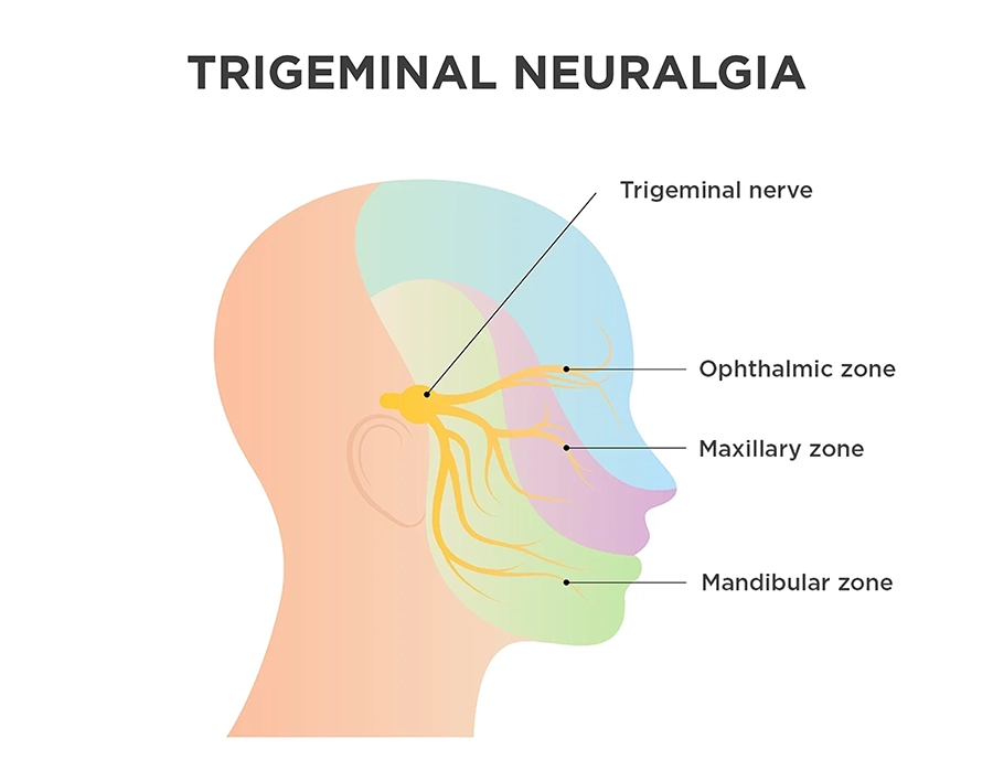 Image shows trigeminal nerve affects three zones of the face: ophthalmic, maxillary and mandibular.