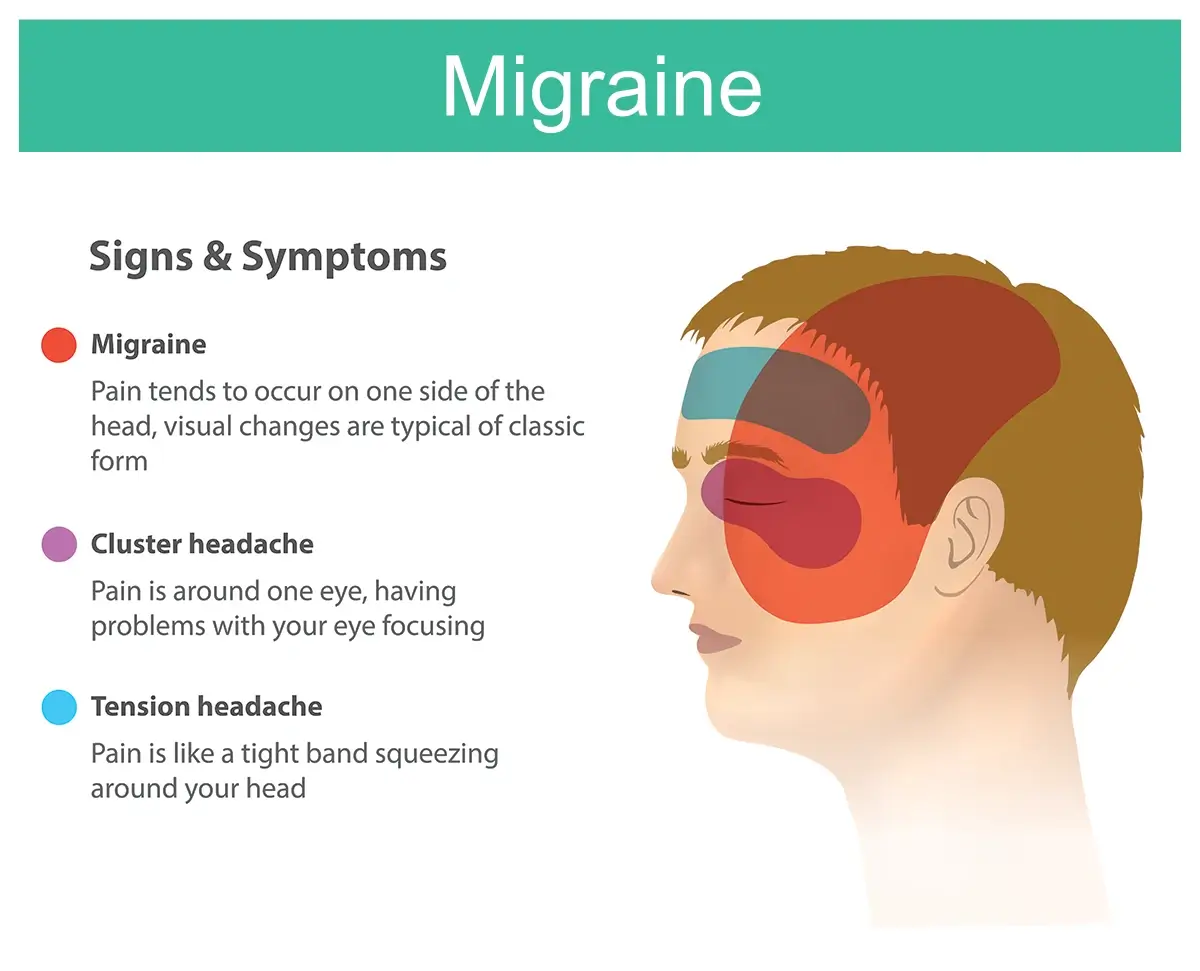 The image shows the different locations of pain for a tension headache (forehead), cluster headache (eye) and one side of the face (migraine).