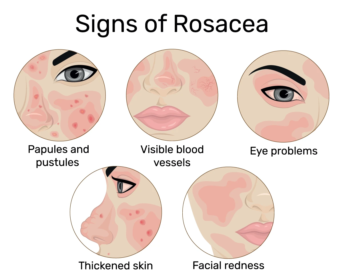 Image shows the signs of rosacea, including papules and pustules, visible blood vessels, eye problems, thickened skin and facial redness.